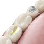 dental fillings