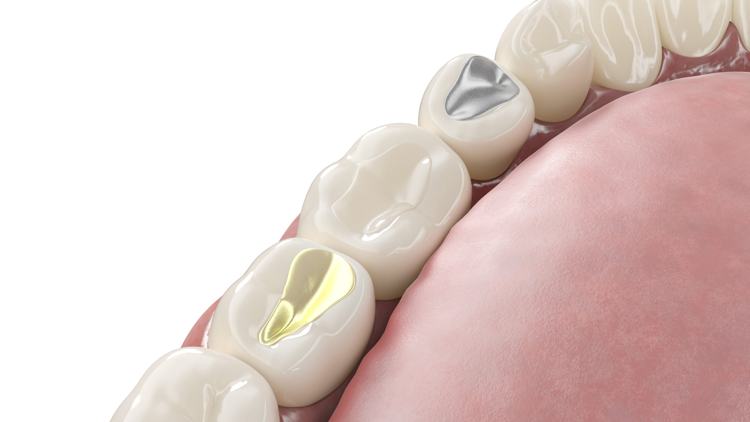 dental fillings